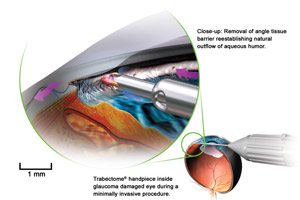 Техніки та пристрої для покращення мікроінвазивної хірургії глаукоми