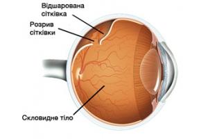 Відшарування сітківки