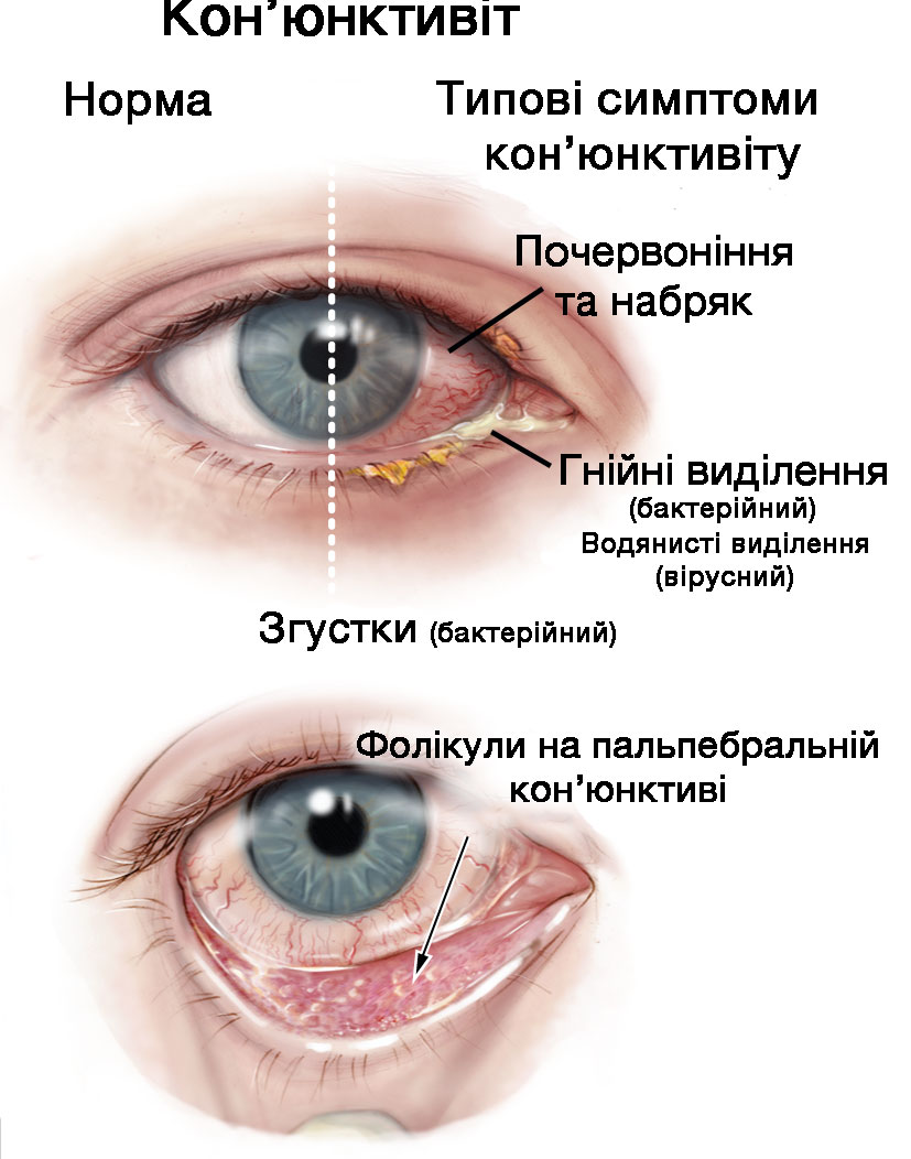Кон'юктивіт